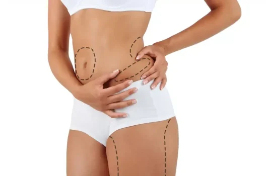 Lipomarcacion-e1738636309855