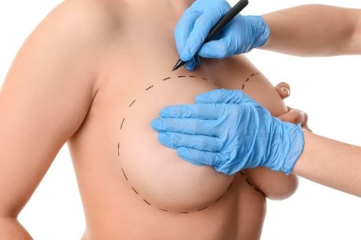 mamoplastia-1